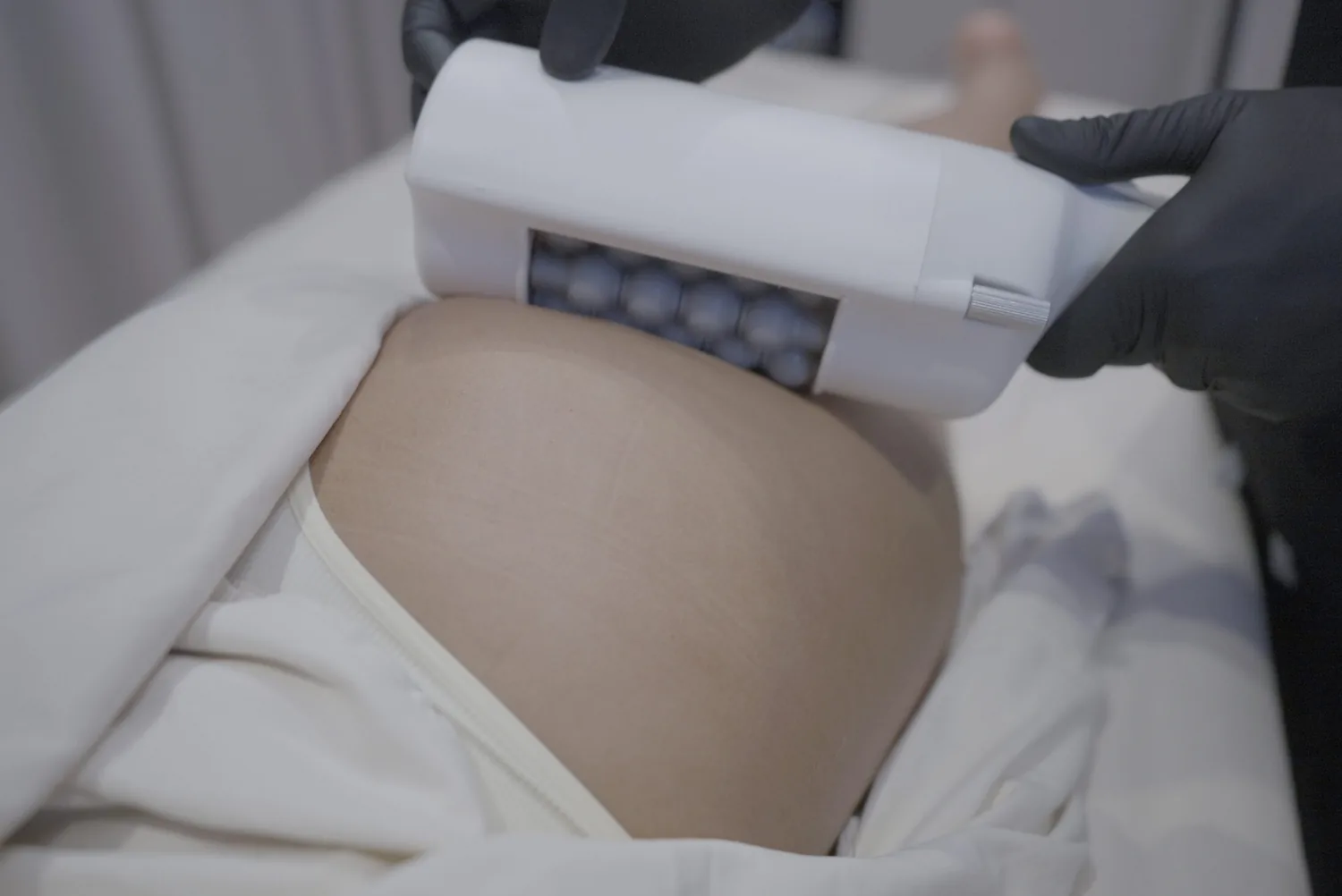 The T-Shape 2 mesospheric handpiece worked across a client's abdomen