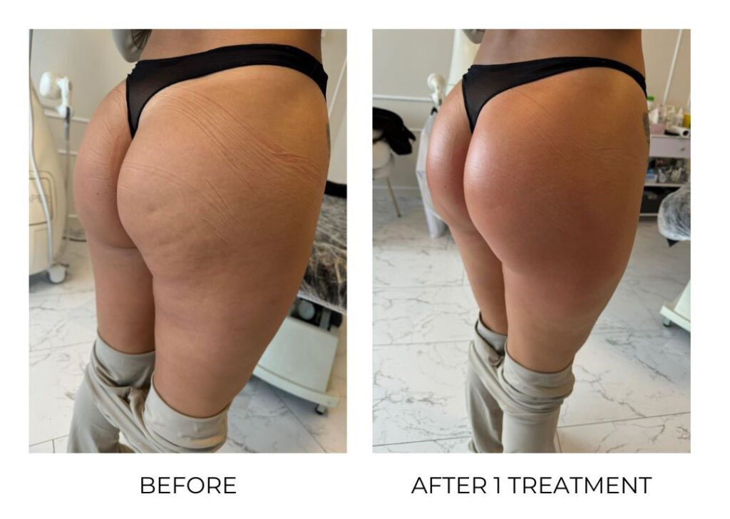 T-Shape Before and After 1 Treatment